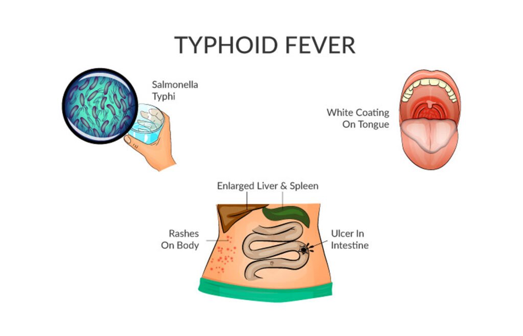 TYPHOED FEVER